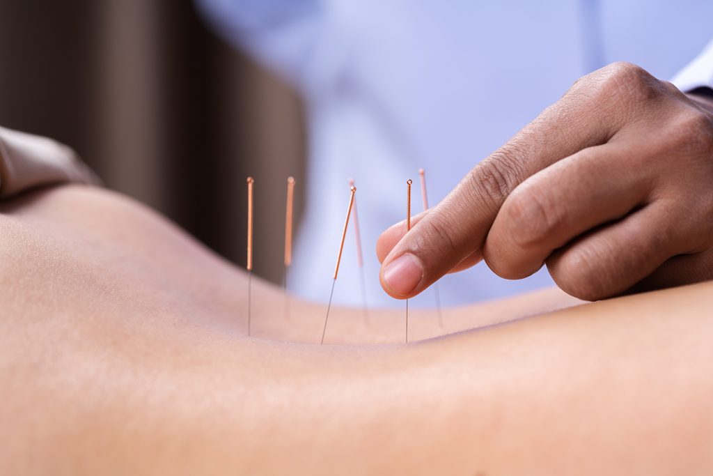 woman undergoing acupuncture treatment on back