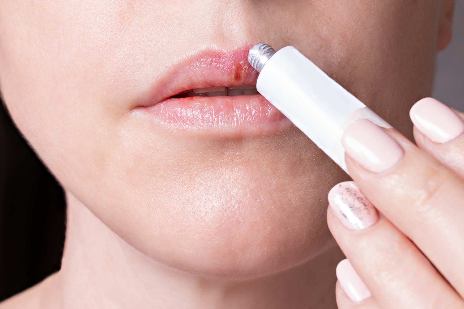 herpes labial