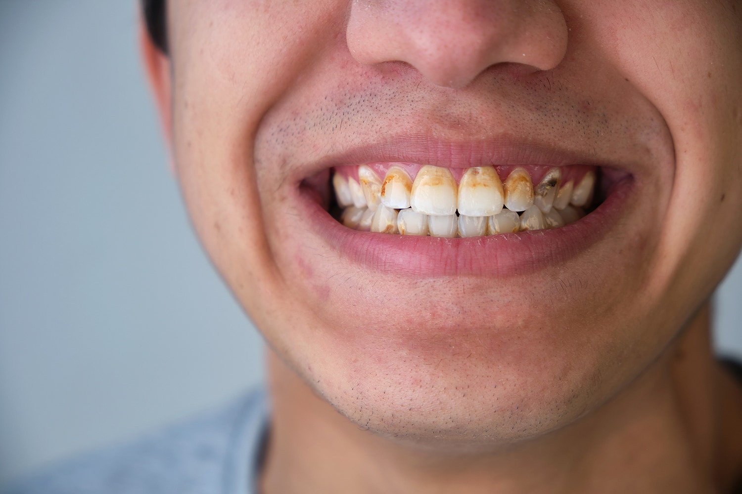necrosis dental