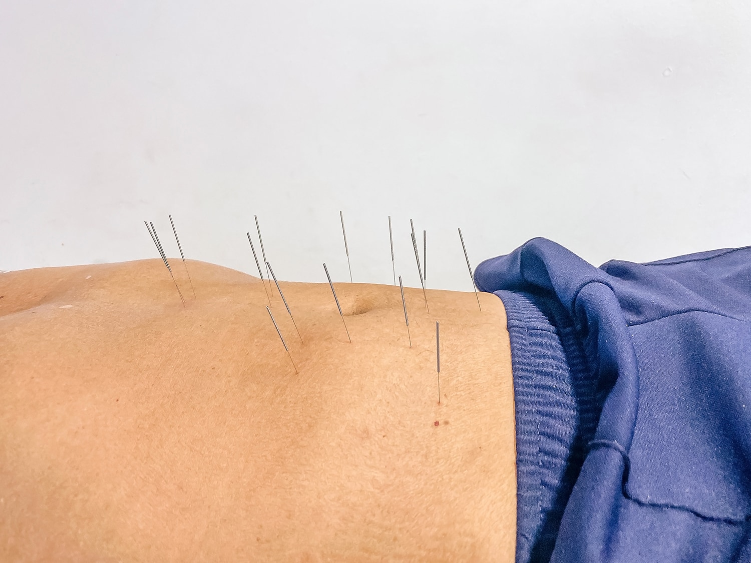 duracion tratamiento acupuntura