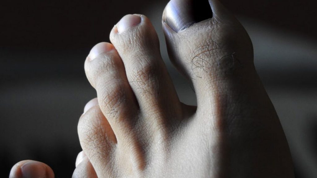 uña negra running podologo