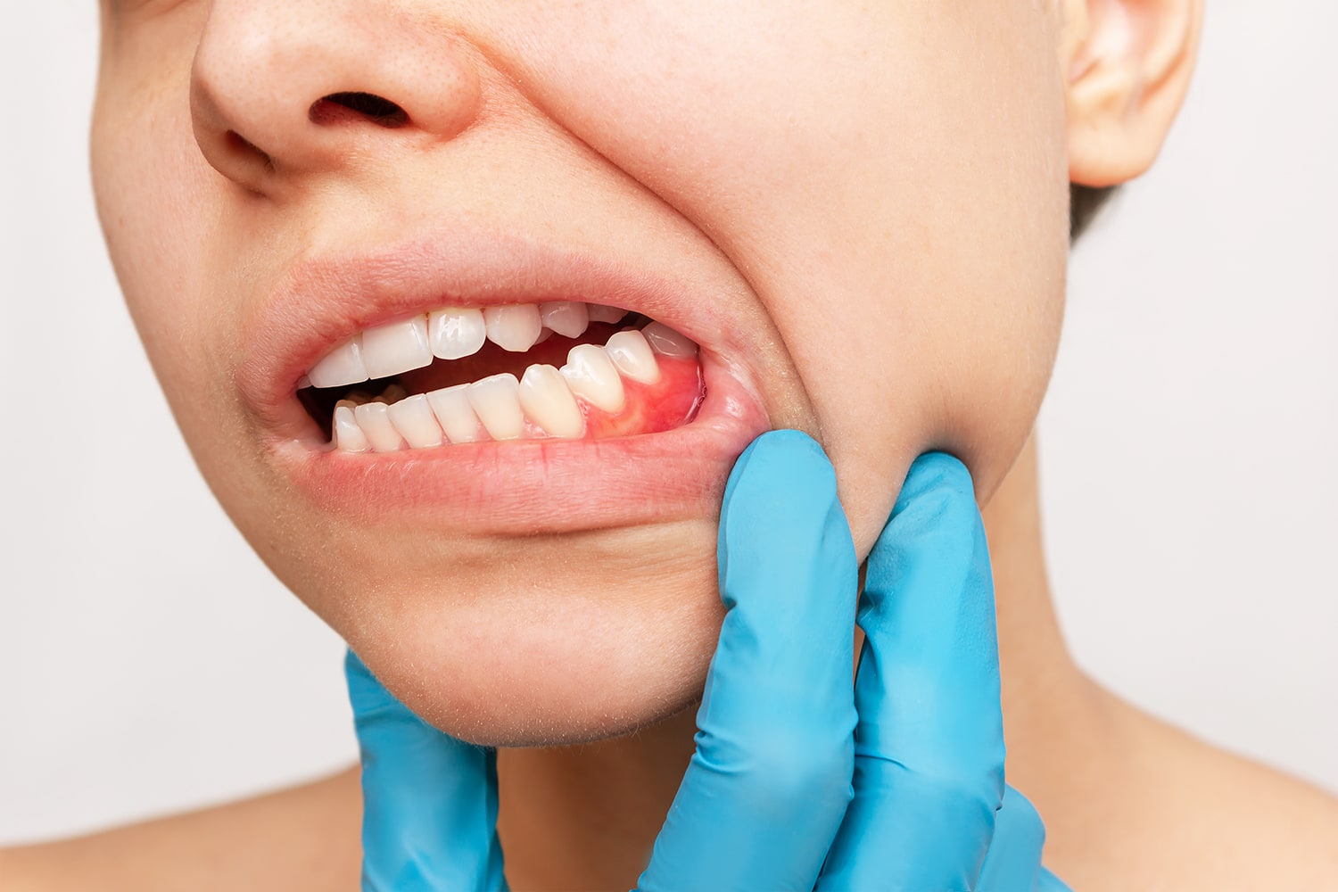 enfermedad periodontal