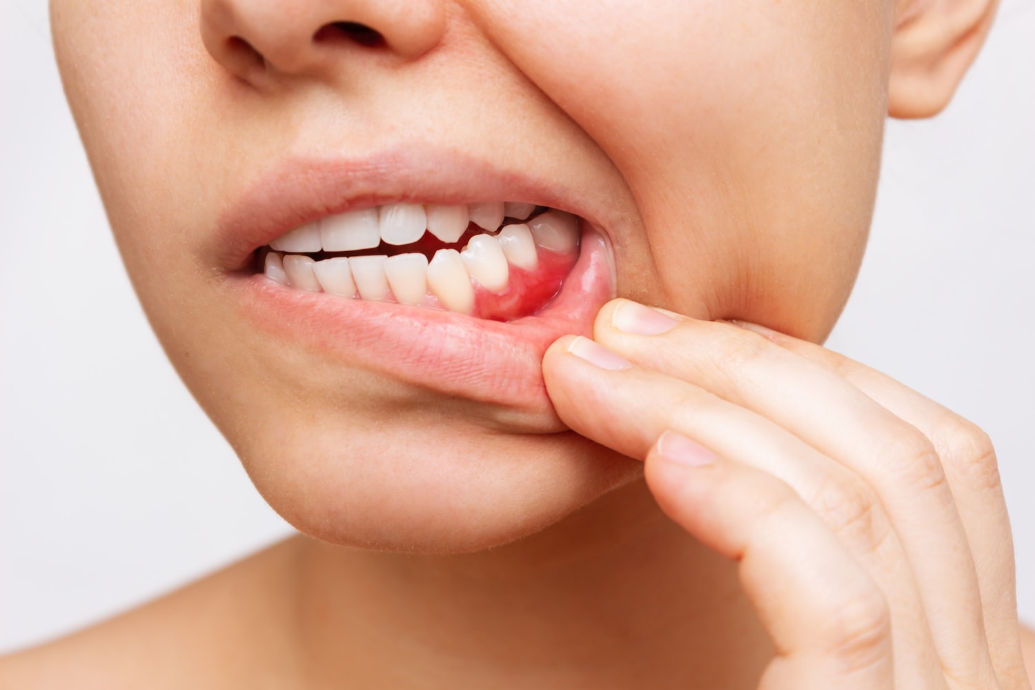 periodontitis se contagia