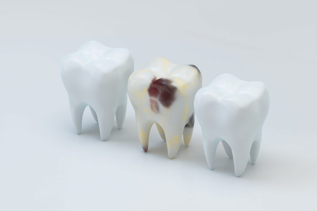caries radicular