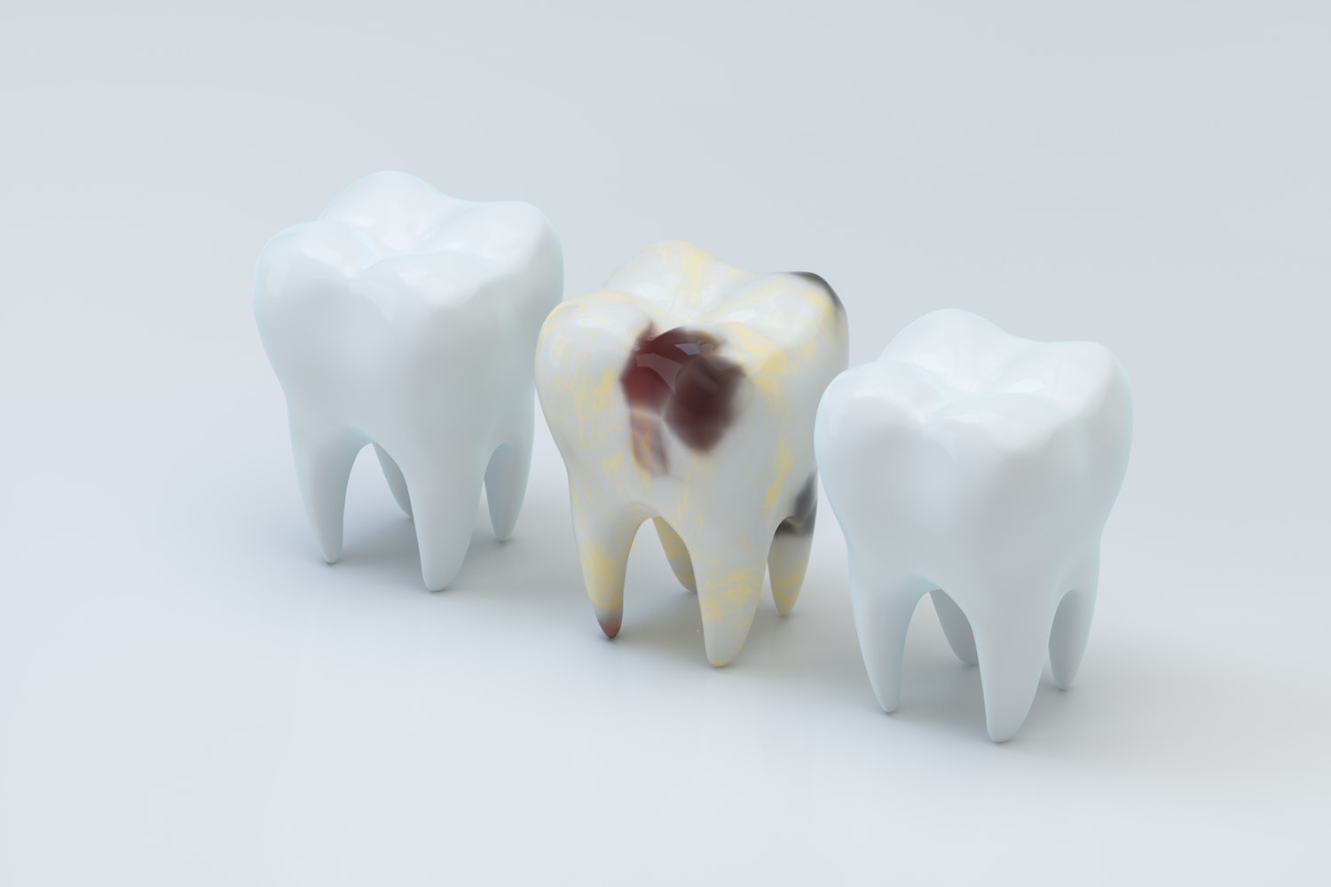 caries radicular